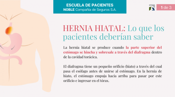 HERNIA HIATAL: LO QUE LOS PACIENTES DEBERÍAN SABER – NOBLE SEGUROS